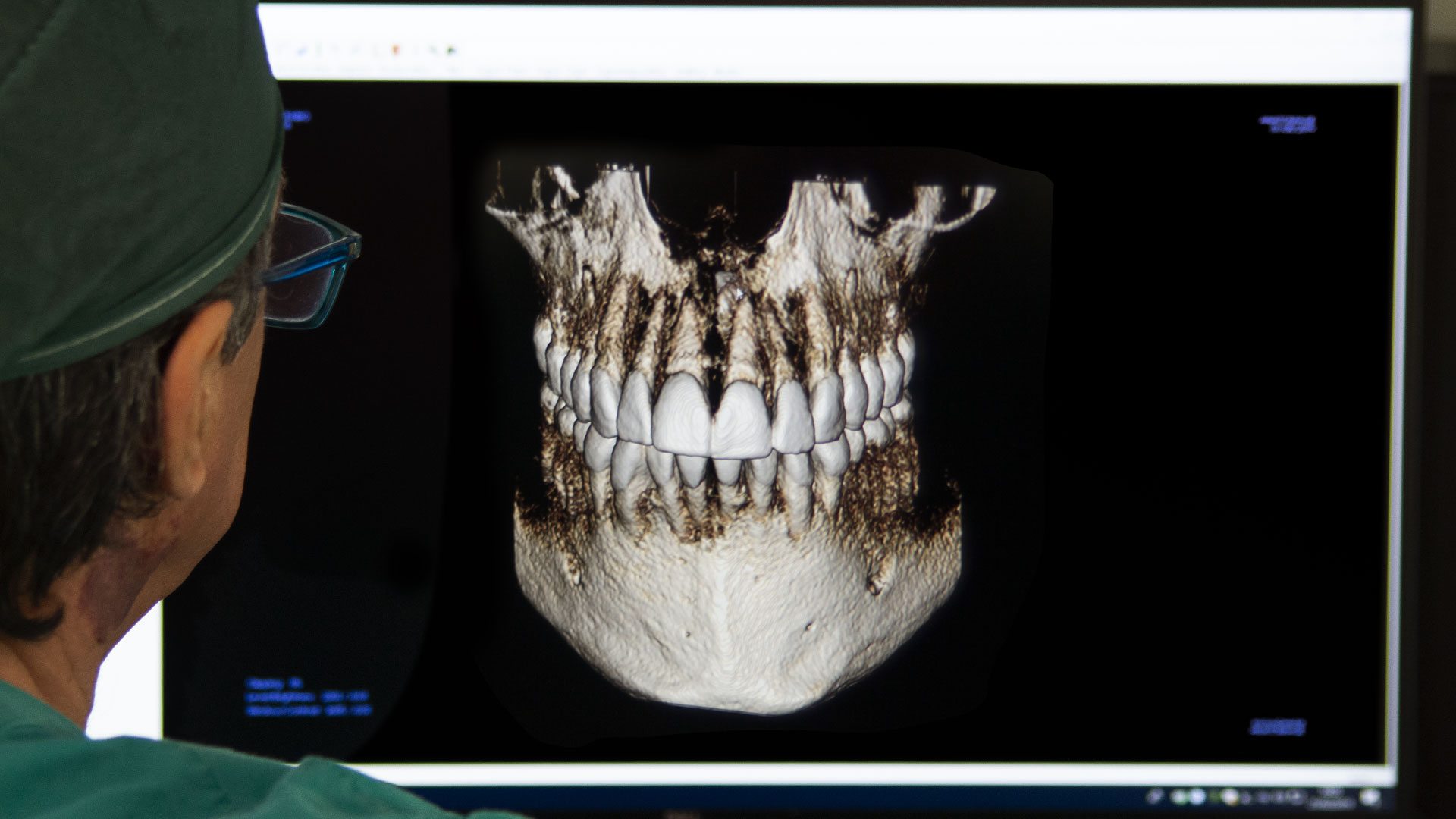 Mandibular regeneration after immediate load dental implant in a periodontitis patient 